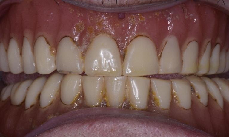 Dentures-Before-Image
